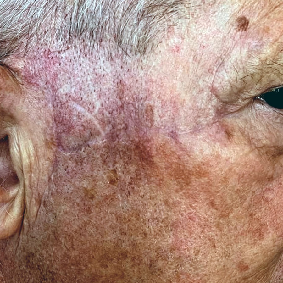 Asportazione di carcinoma spinocellulare della tempia: dopo l&rsquo;intervento