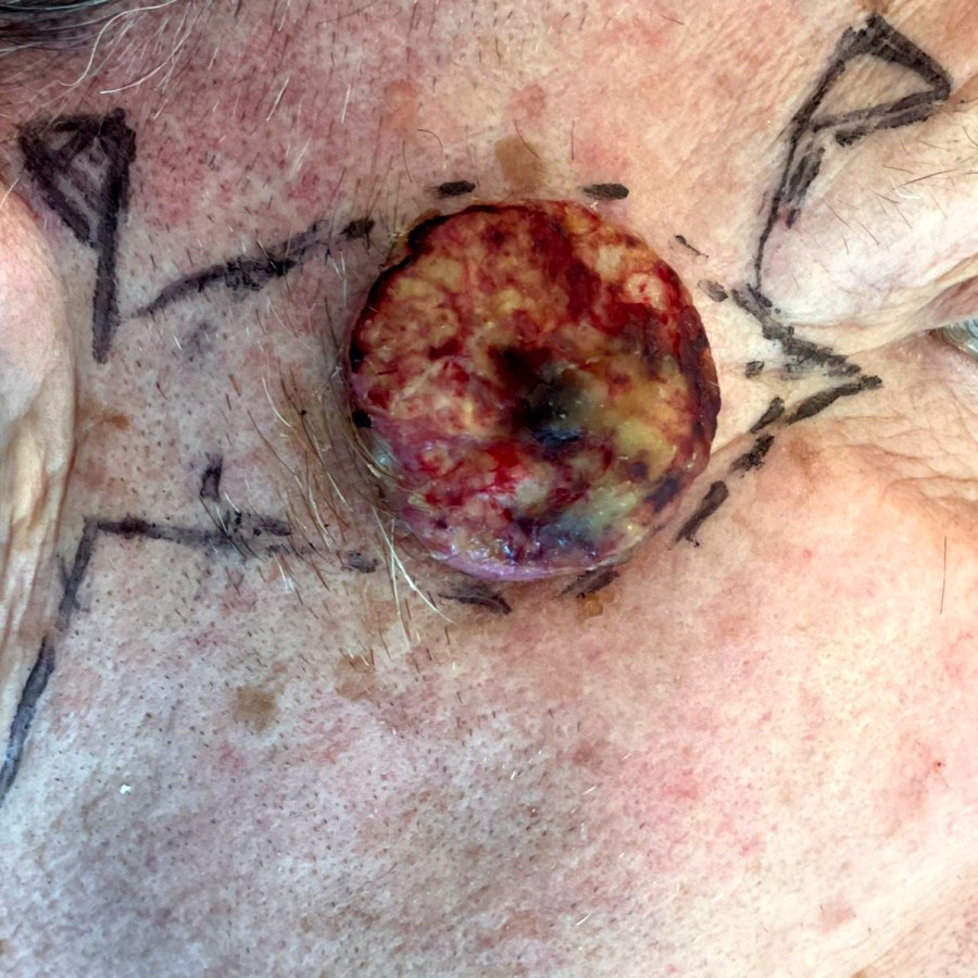 Asportazione di carcinoma spinocellulare della tempia: prima dell&rsquo;intervento