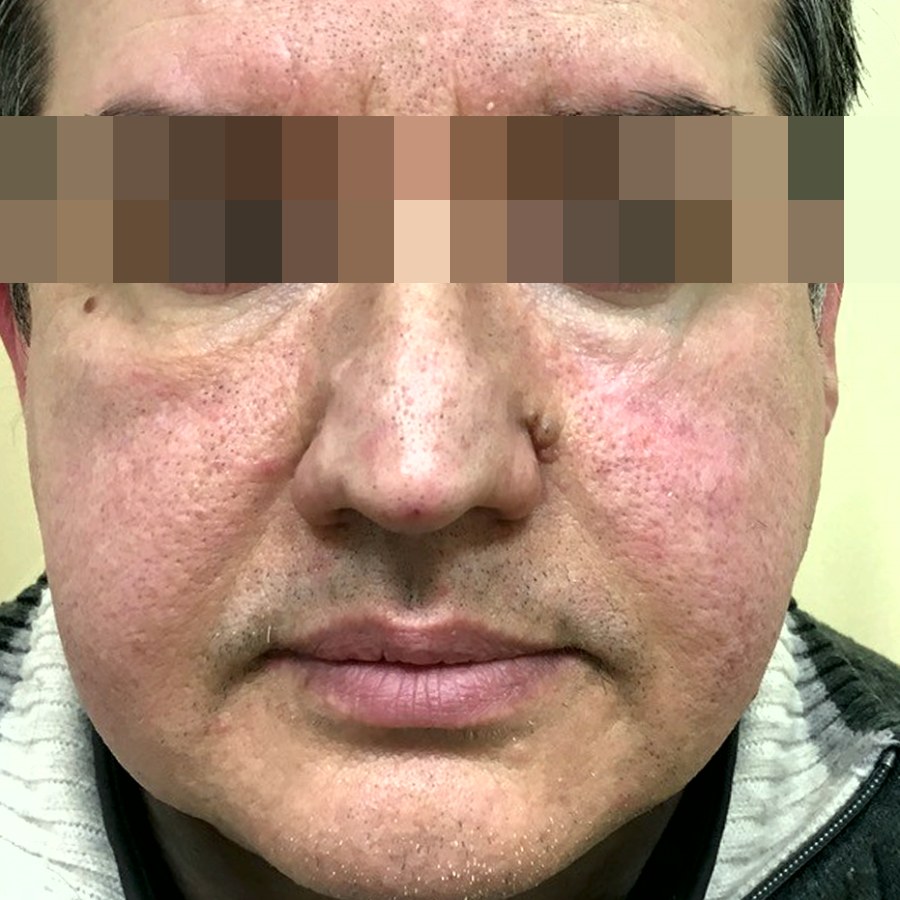 Asportazione di carcinoma spinocellulare del volto: dopo l&rsquo;intervento