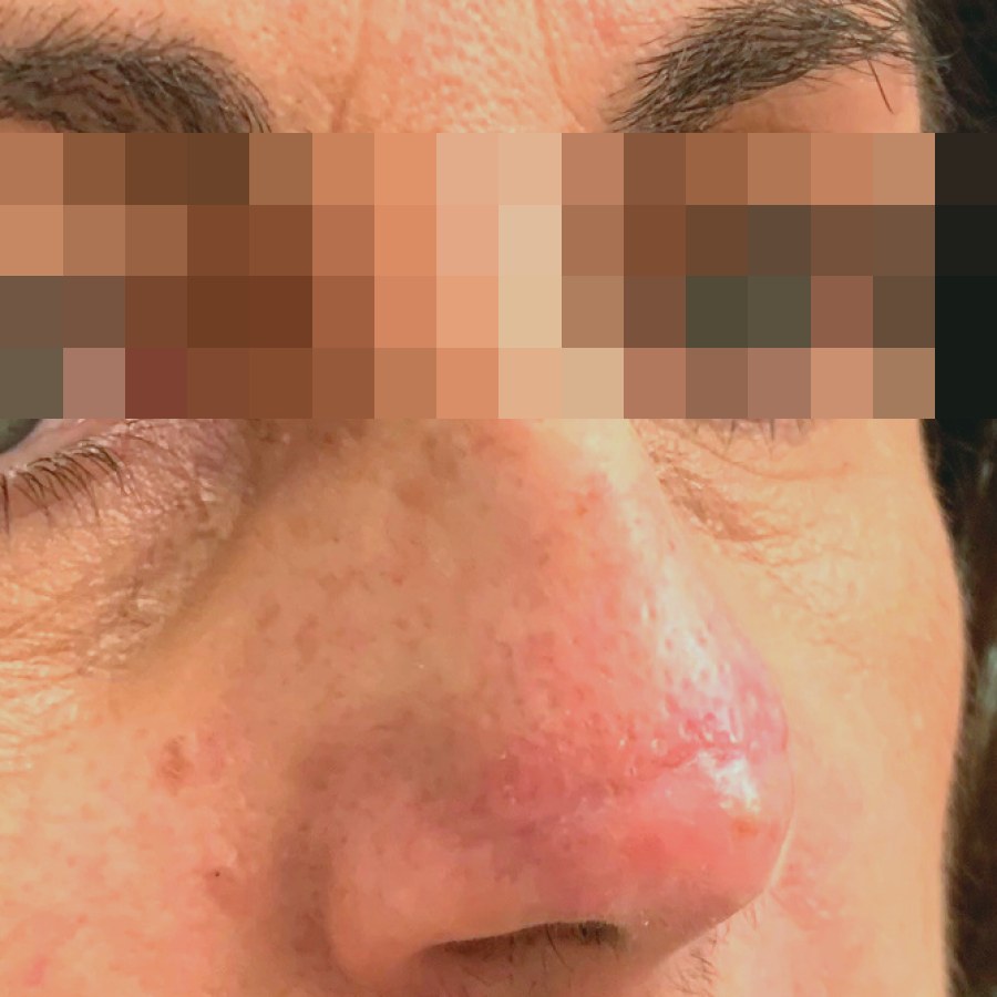 Asportazione di epitelioma del naso, caso 1: dopo l&rsquo;intervento