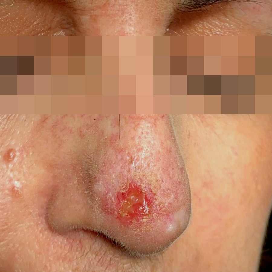 Asportazione di epitelioma del naso, caso 1: prima dell&rsquo;intervento
