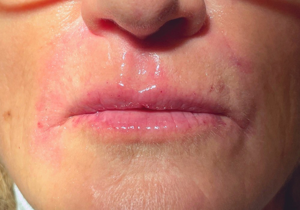 Filler labbra, caso 2: dopo il trattamento