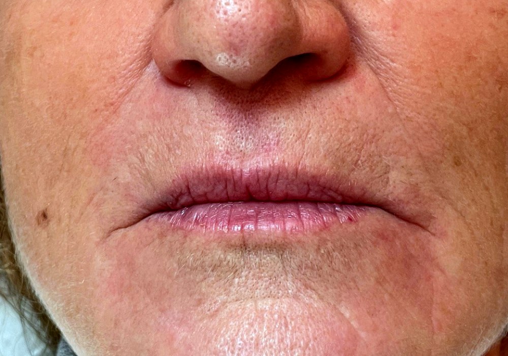 Filler labbra, caso 2: prima del trattamento