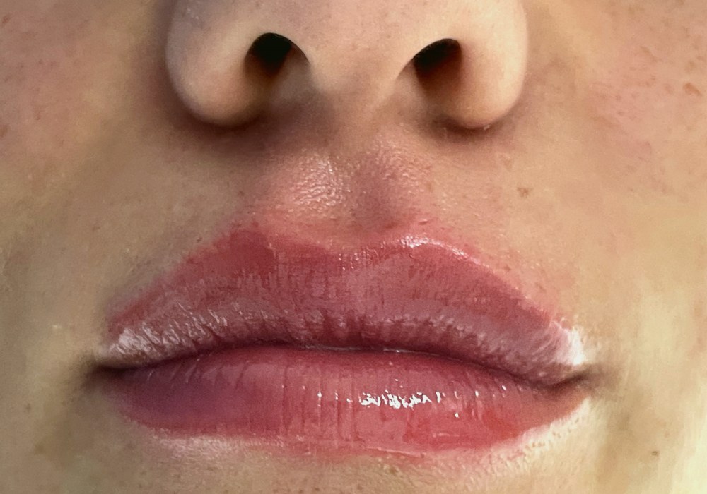 Filler labbra, caso 3: dopo il trattamento