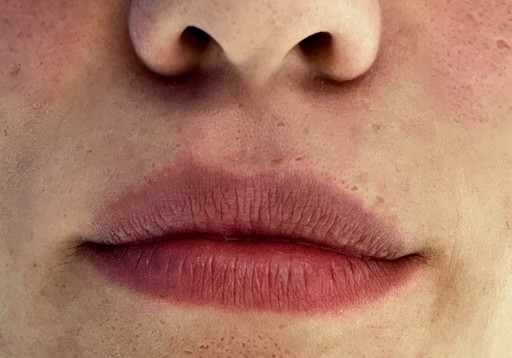 Filler labbra, caso 3: prima del trattamento