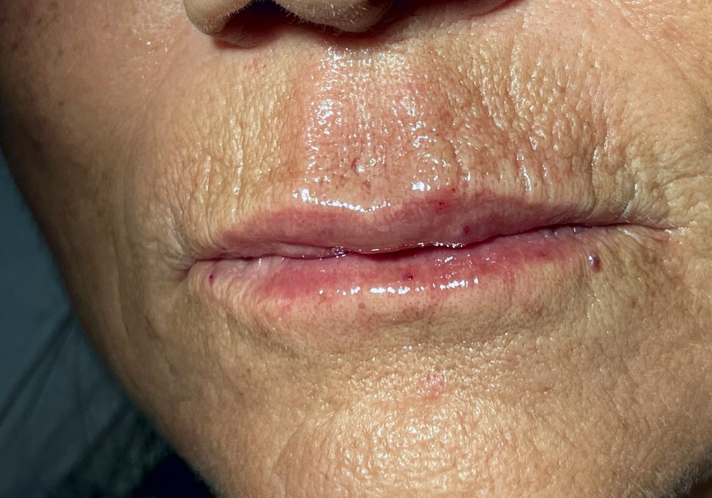 Filler labbra, caso 4: dopo il trattamento