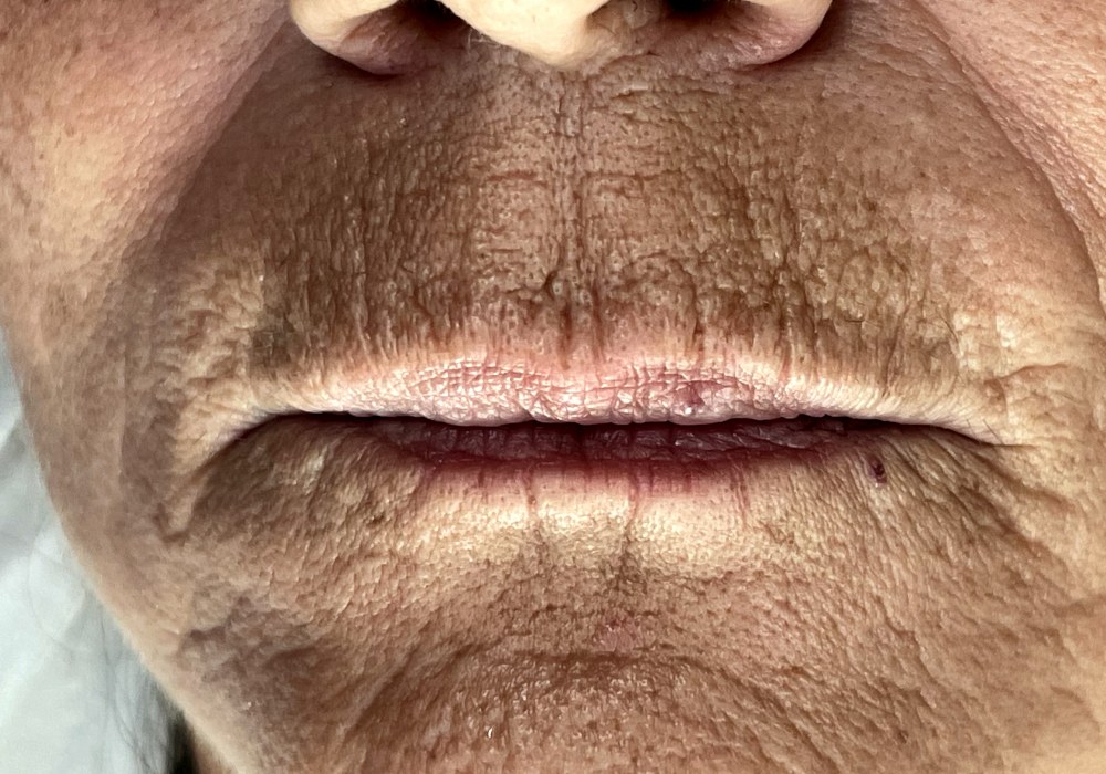 Filler labbra, caso 4: prima del trattamento