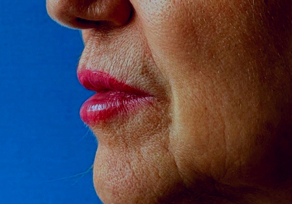 Filler di labbra e solchi naso-labiali, caso 1, vista di tre quarti: dopo il trattamento