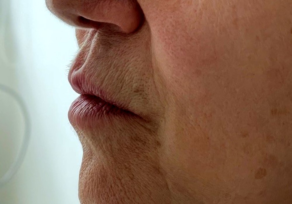 Filler di labbra e solchi naso-labiali, caso 1, vista di tre quarti: prima del trattamento