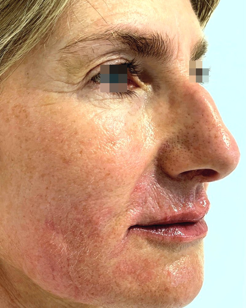 Lipofilling del viso, caso 1: dopo l&rsquo;intervento