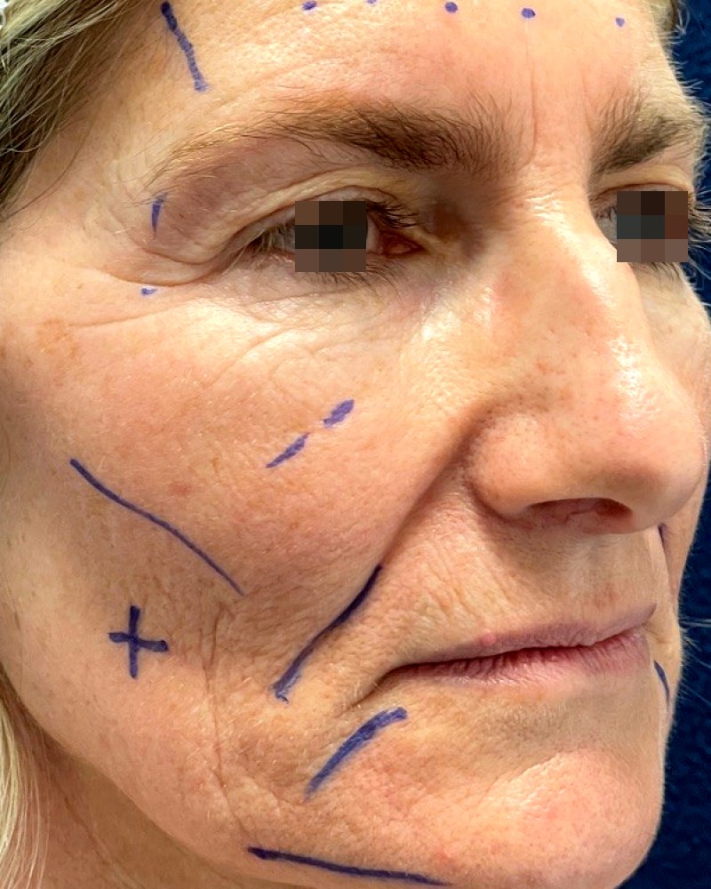 Lipofilling del viso, caso 1: prima dell&rsquo;intervento
