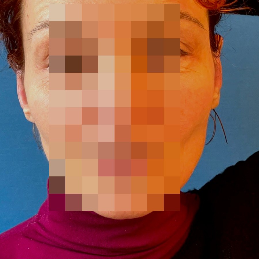 Otoplastica, caso 1: dopo l&rsquo;intervento