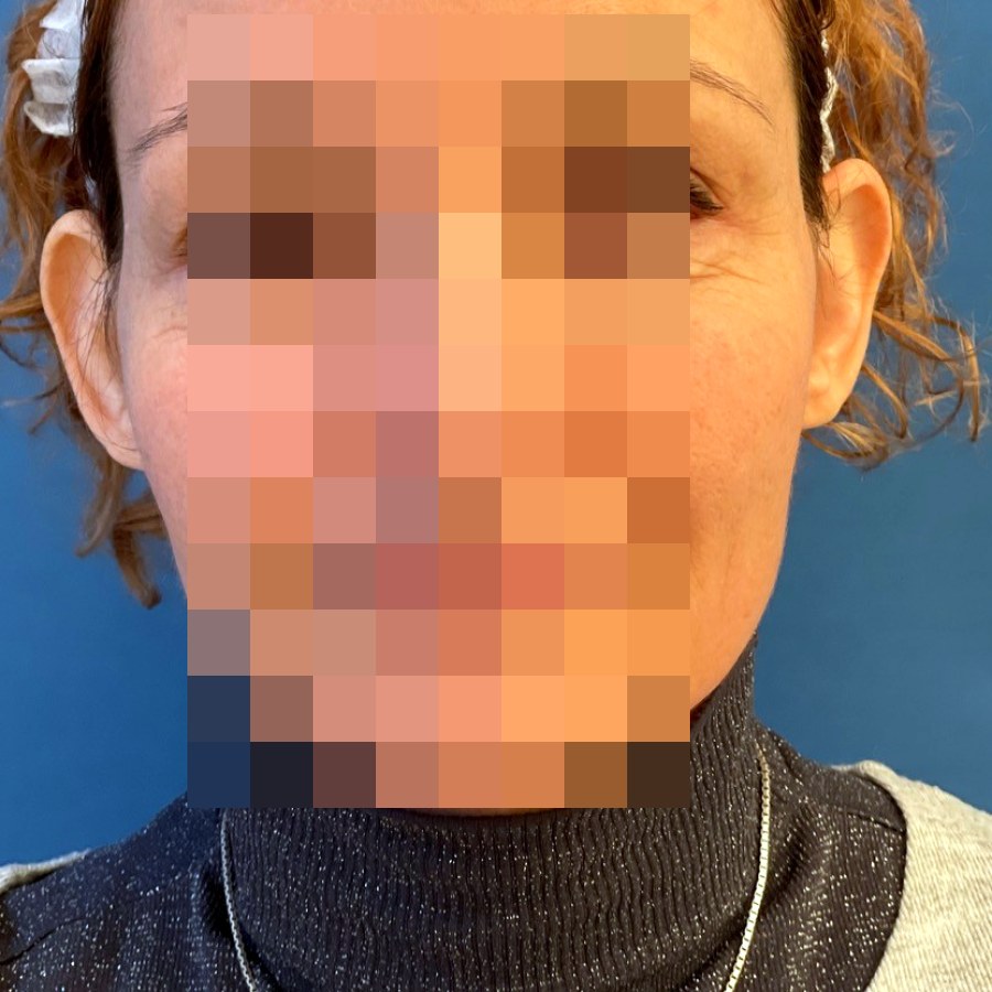 Otoplastica, caso 1: prima dell&rsquo;intervento
