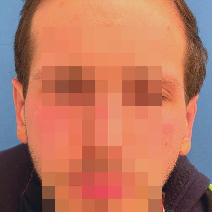 Otoplastica, caso 2, vista frontale: dopo l&rsquo;intervento