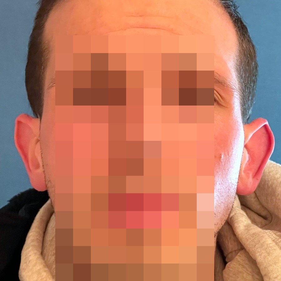 Otoplastica, caso 2, vista frontale: prima dell&rsquo;intervento