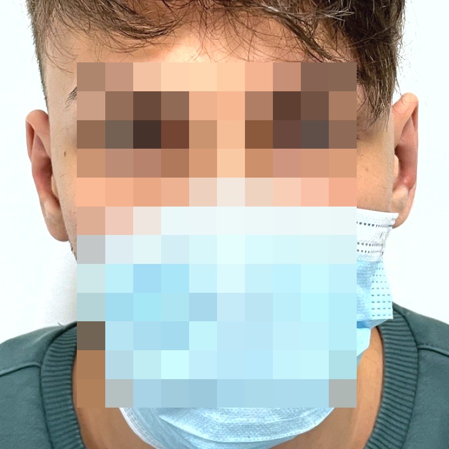 Otoplastica, caso 3: dopo l&rsquo;intervento