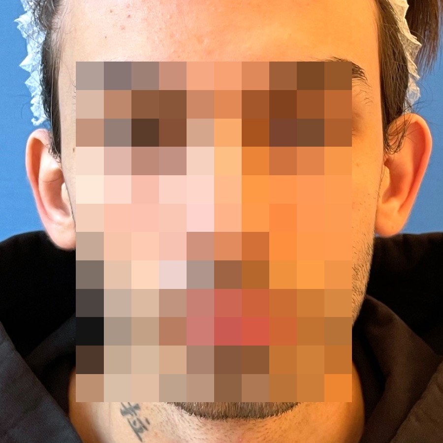 Otoplastica, caso 3: prima dell&rsquo;intervento