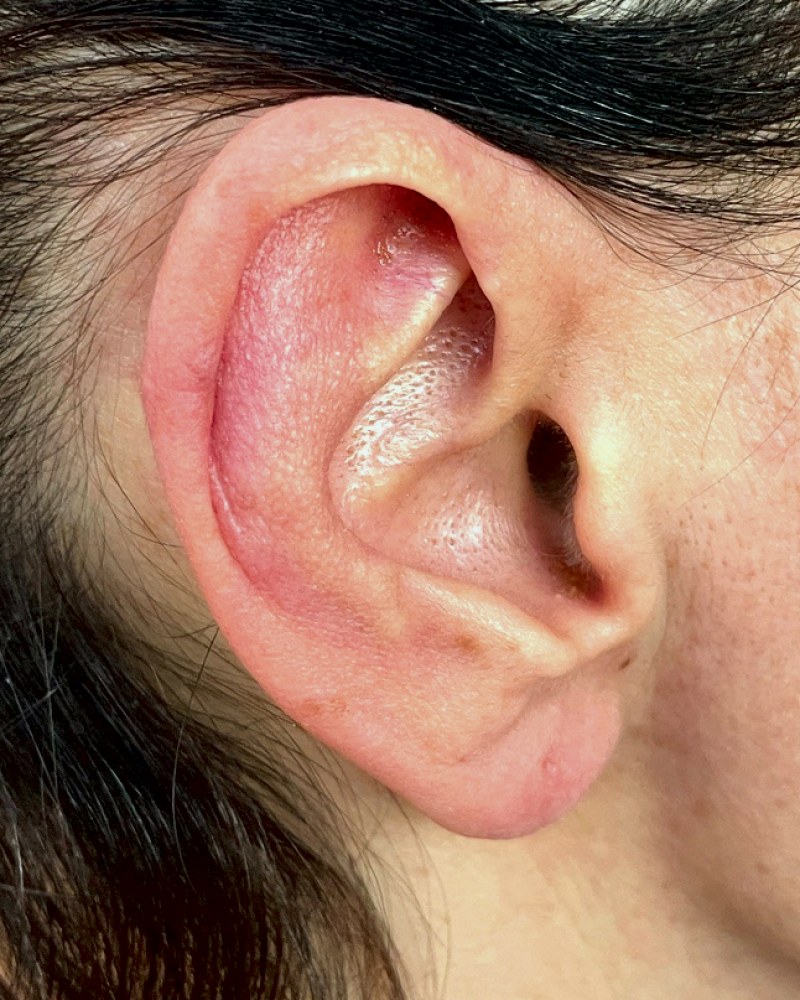 Riduzione del padiglione auricolare, orecchio destro: dopo l&rsquo;intervento