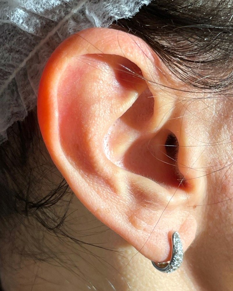 Riduzione del padiglione auricolare, orecchio destro: prima dell&rsquo;intervento
